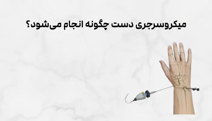 میکروسرجری دست چگونه انجام میشود؟