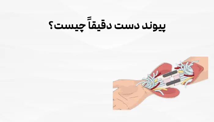 پیوند دست دقیقاً چیست؟